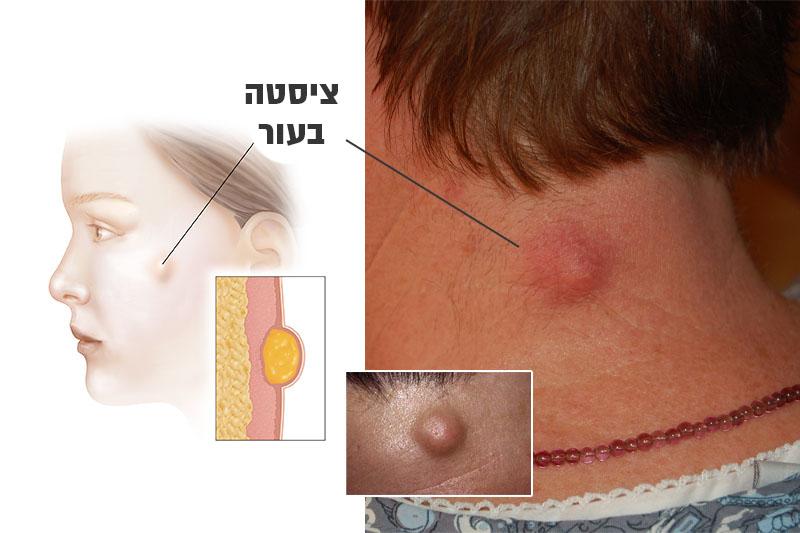 ציסטה בעור – תסמינים, גורמים ודרכי טיפול