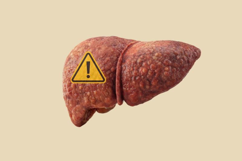 4 סימנים מוקדמים לכבד שומני (ואיך לטפל בזה)