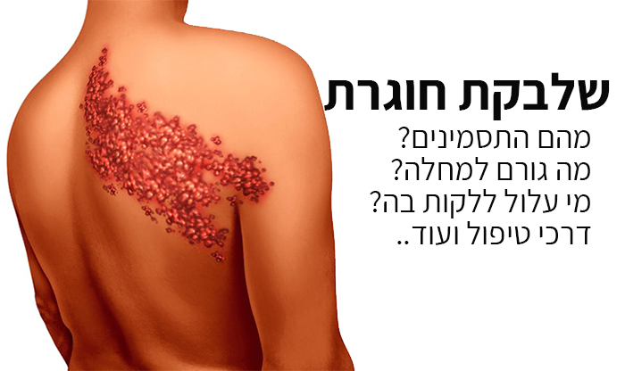שלבקת חוגרת: גורמים, תסמינים ודרכי טיפול