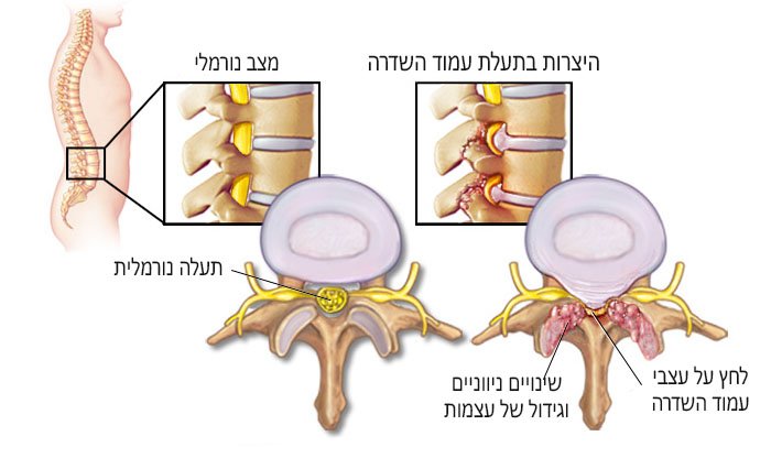 היצרות תעלת עמוד השדרה: תסמינים, גורמים, אבחון וטיפול