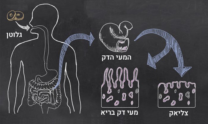 מחלת הצליאק: גורמים, תסמינים, אבחנה, טיפול ומניעה