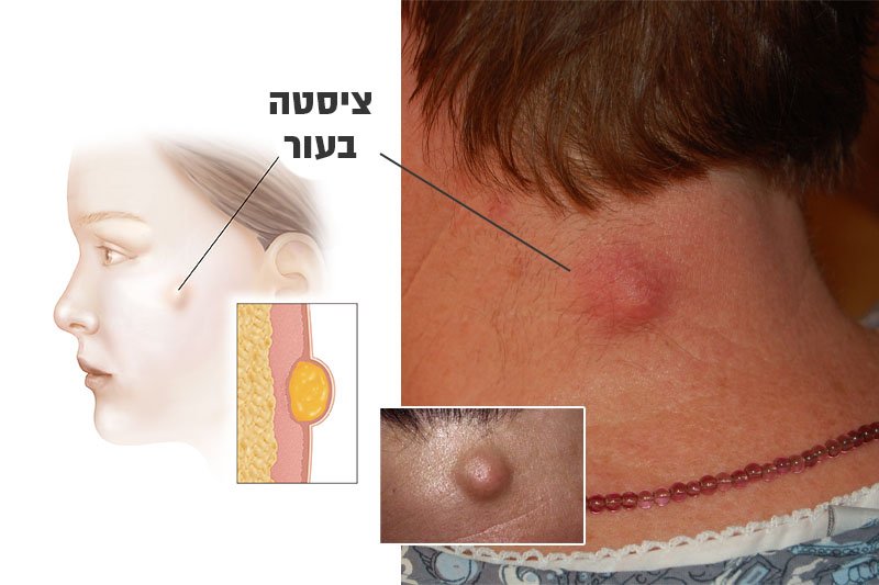 ציסטה בעור – תסמינים, גורמים ודרכי טיפול