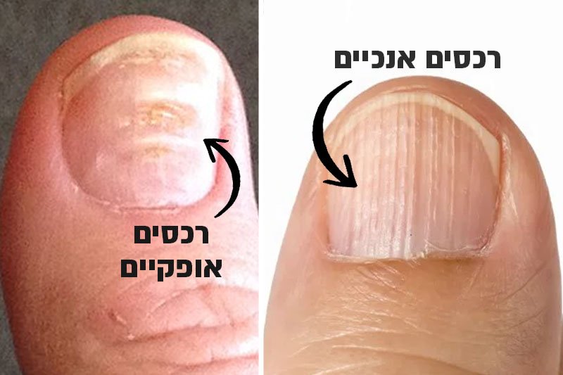 למה יש לי רכסים בציפורניים?