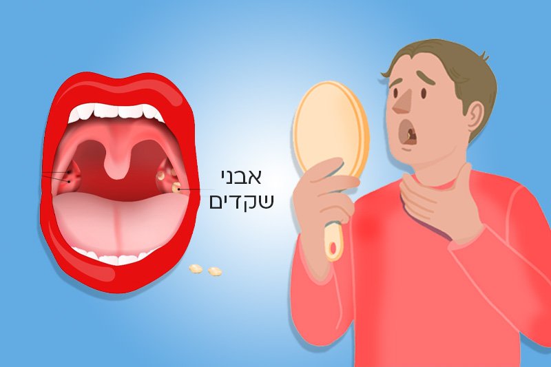זה הסימן שיש לכם אבני שקדים בפה